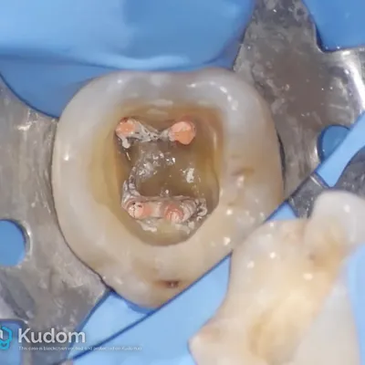 Complex Lower Molar Retreatment - Image 6