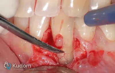 Riassorbimento Esterno Canino Inferiore - Immagine 6