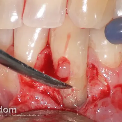 Lower Canine External Resorption - Image 6