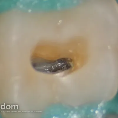 Upper Molar Root Canal Treatment - Image 6