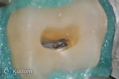 Terapia Canalare Molare Superiore - Immagine 6