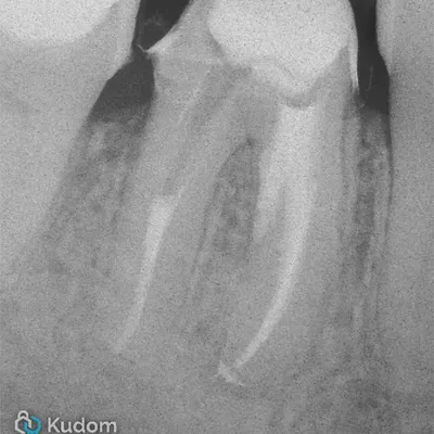 Lower Molar Iatrogenic Perforation - Image 6