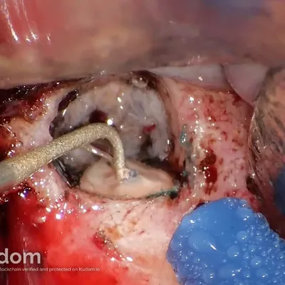 Apical Microsurgery of Upper Molar Mesiobuccal Root - Image 6
