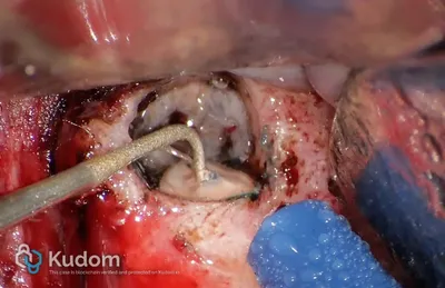 Microchirurgia Apicale Radice Mesio-Vestibolare di Molare Superiore - Immagine 6