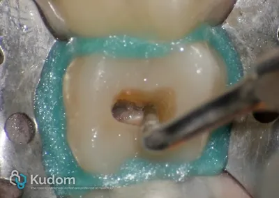 Terapia Canalare Molare Superiore - Immagine 7