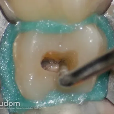 Upper Molar Root Canal Treatment - Image 7