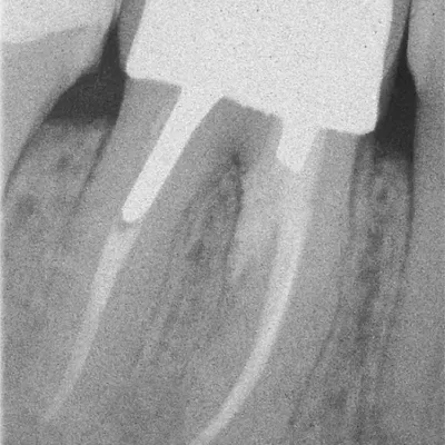 Lower Molar Iatrogenic Perforation - Image 7