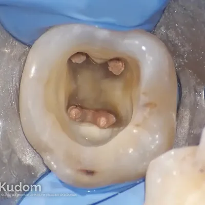 Complex Lower Molar Retreatment - Image 7