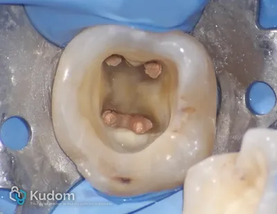 Ritrattamento Complesso Molare Inferiore - Immagine 7