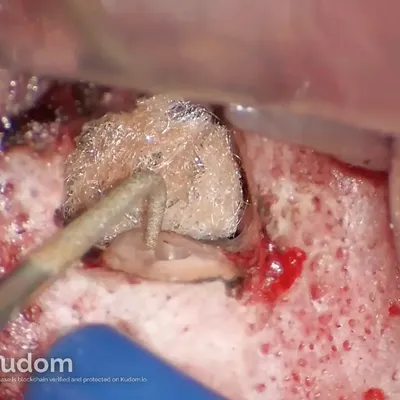Apical Microsurgery of Upper Molar Mesiobuccal Root - Image 7