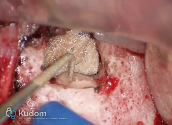 Microchirurgia Apicale Radice Mesio-Vestibolare di Molare Superiore