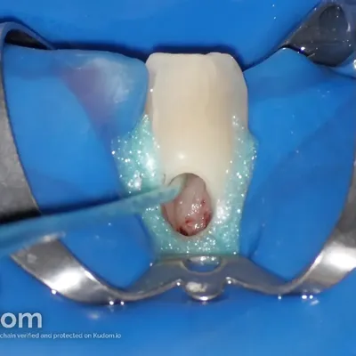 Lower Canine External Resorption - Image 7