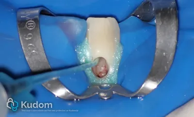 Riassorbimento Esterno Canino Inferiore - Immagine 7