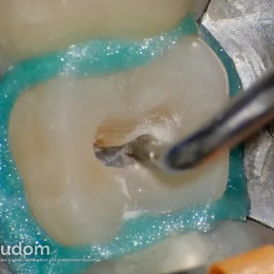 Upper Molar Root Canal Treatment - Image 8