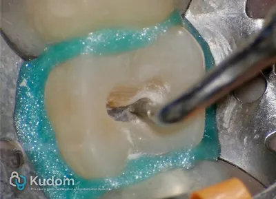 Terapia Canalare Molare Superiore - Immagine 8