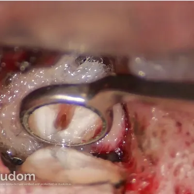 Apical Microsurgery of Upper Molar Mesiobuccal Root - Image 8