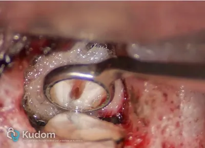 Microchirurgia Apicale Radice Mesio-Vestibolare di Molare Superiore - Immagine 8