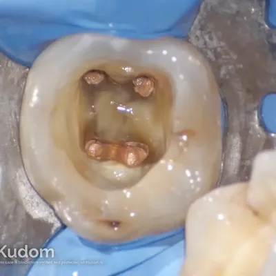 Complex Lower Molar Retreatment - Image 8
