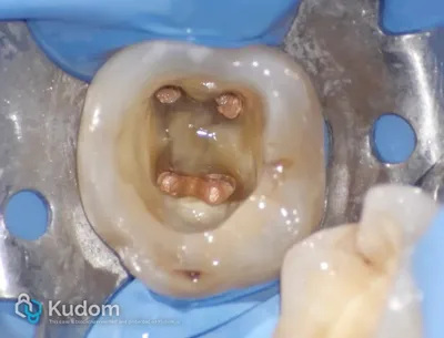 Ritrattamento Complesso Molare Inferiore - Immagine 8