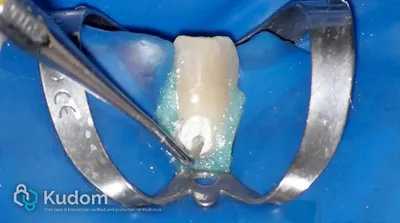 Riassorbimento Esterno Canino Inferiore - Immagine 8