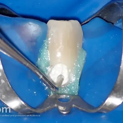 Lower Canine External Resorption - Image 8