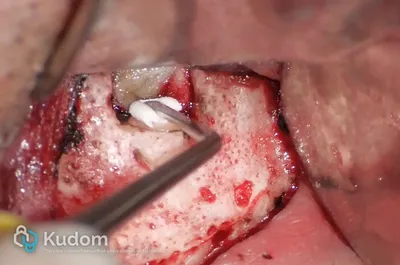 Microchirurgia Apicale Radice Mesio-Vestibolare di Molare Superiore - Immagine 9