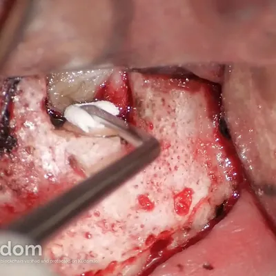 Apical Microsurgery of Upper Molar Mesiobuccal Root - Image 9
