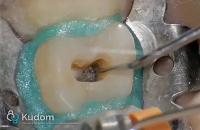 Terapia Canalare Molare Superiore - Immagine 9