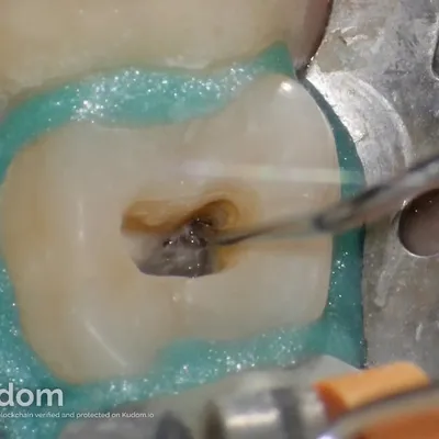 Upper Molar Root Canal Treatment - Image 9