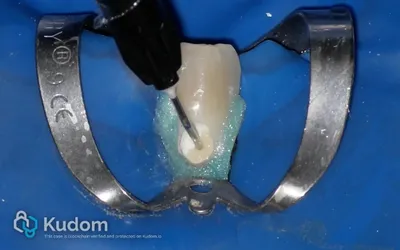 Riassorbimento Esterno Canino Inferiore - Immagine 9