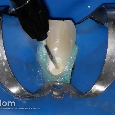 Lower Canine External Resorption - Image 9