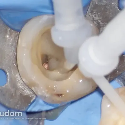 Complex Lower Molar Retreatment - Image 9