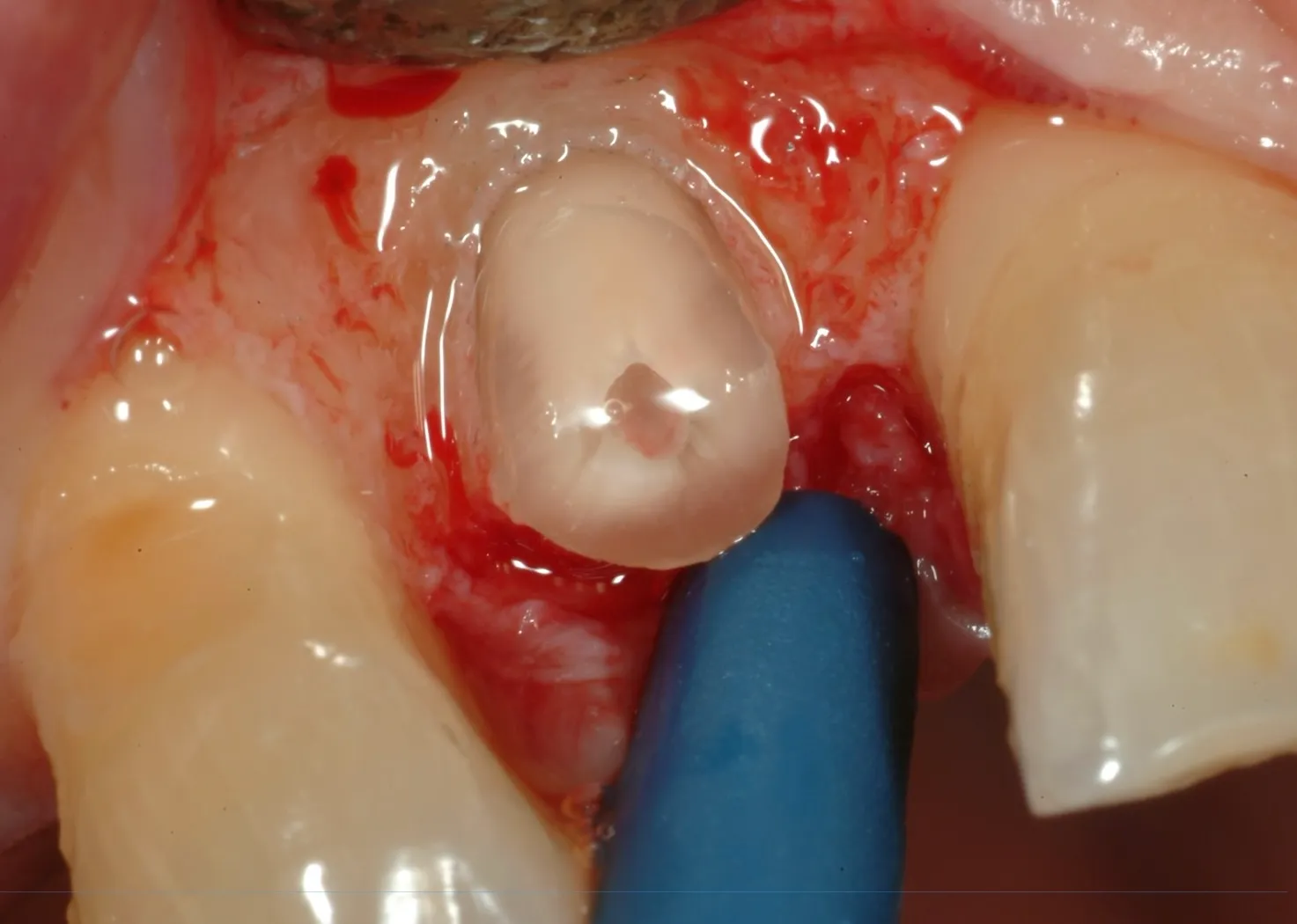 Clinical Crown Lengthening
