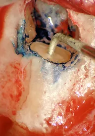 Microchirurgia Endodontica